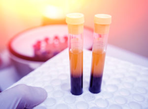 Platelet-Rich plasma preparation. Tube with blood in hands. Centrifuge.