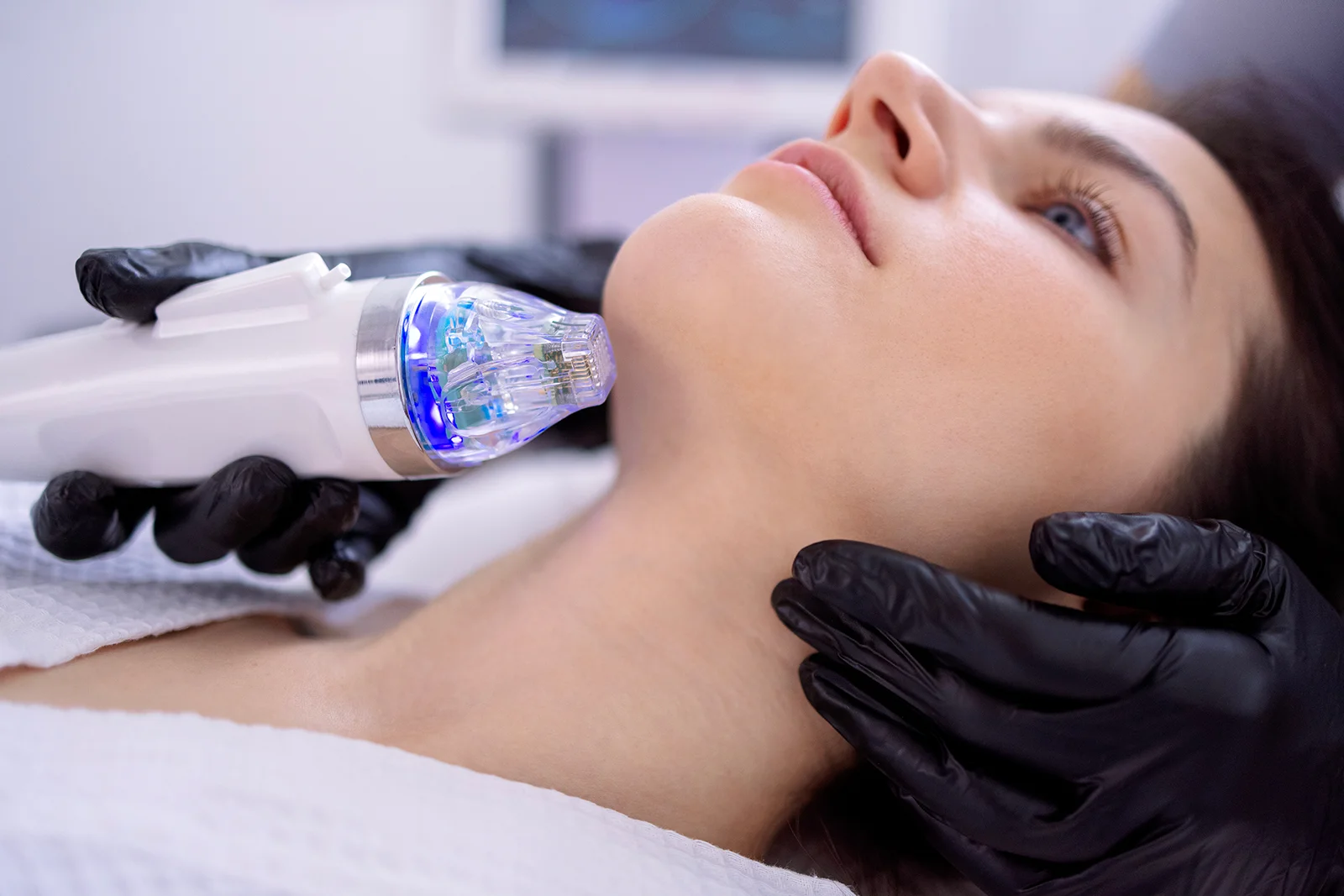 Radiofrequenz-Microneedling